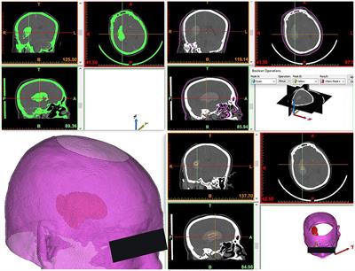 Low-Cost, Accurate, Effective Treatment of Hypertensive Cerebral Hemorrhage With Three-Dimensional Printing Technology
